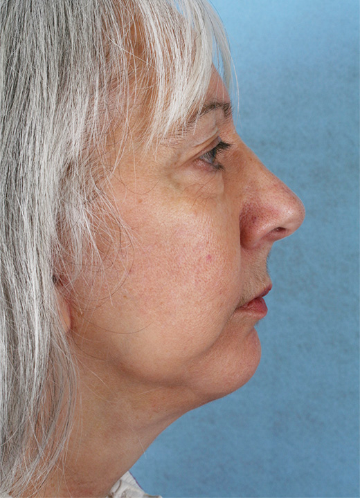 Before Image 1